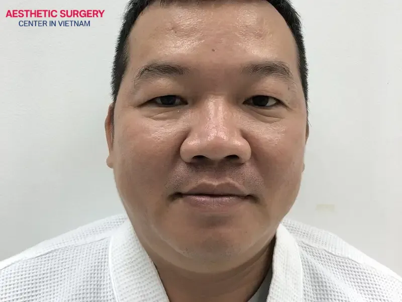 A bulbous nose directly impacts the overall aesthetics of your face