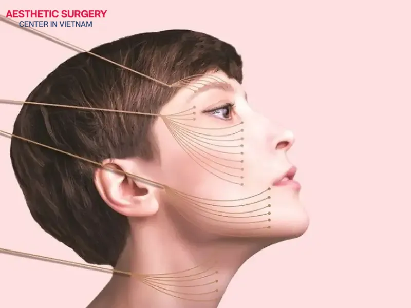 Each type of facelift thread has different properties, thus different prices