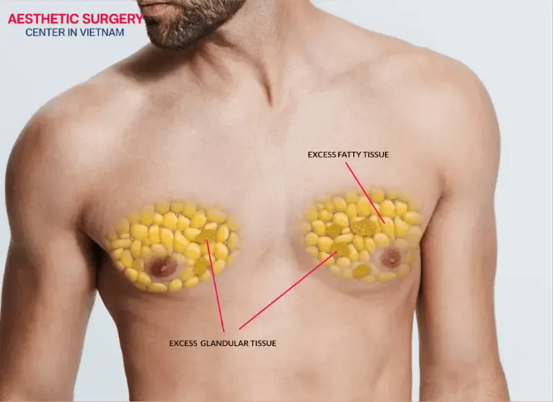 Male breast reduction surgery typically involves liposuction and removal of excess tissue