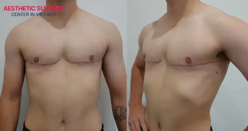 Results after male breast reduction