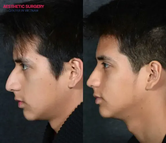Real patient image of Male Semi-structural Rhinoplasty, showing a high nasal bridge and well-proportioned, refined nostrils
