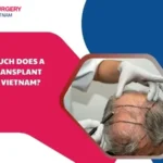 Average cost of hair transplants in vietnam