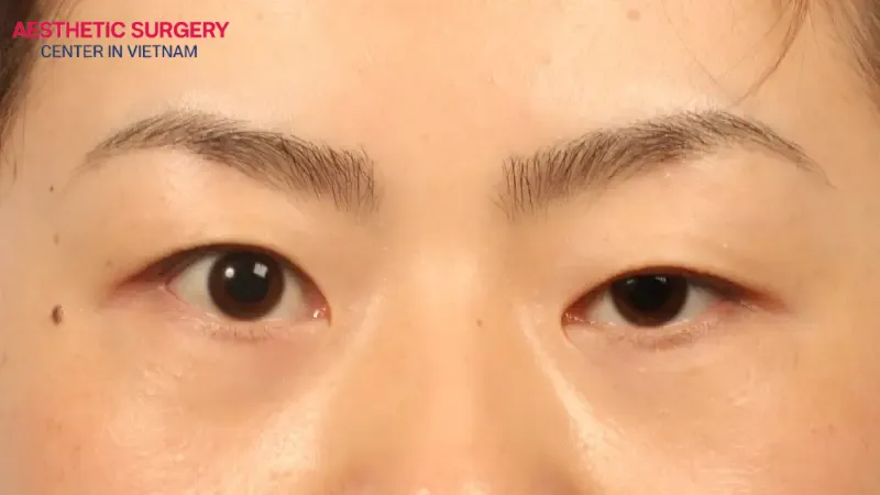 People with monolids often seek eyelid surgery