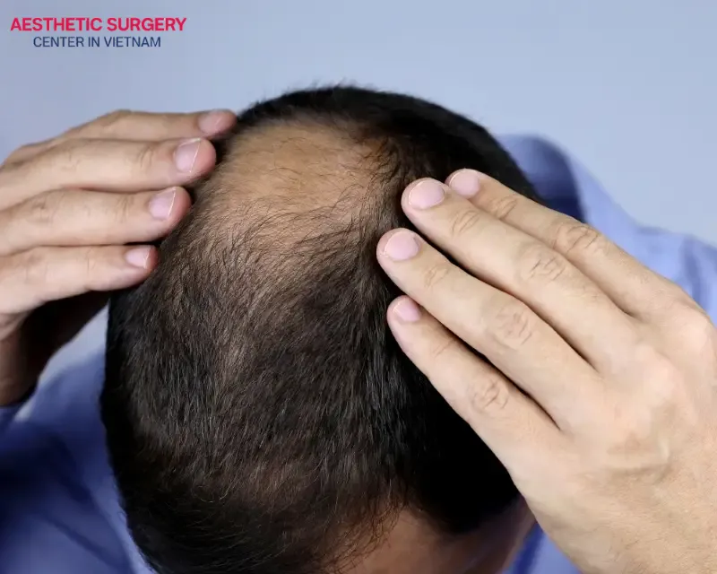 People with mild to moderate hair loss or baldness can consider stem cell hair transplant