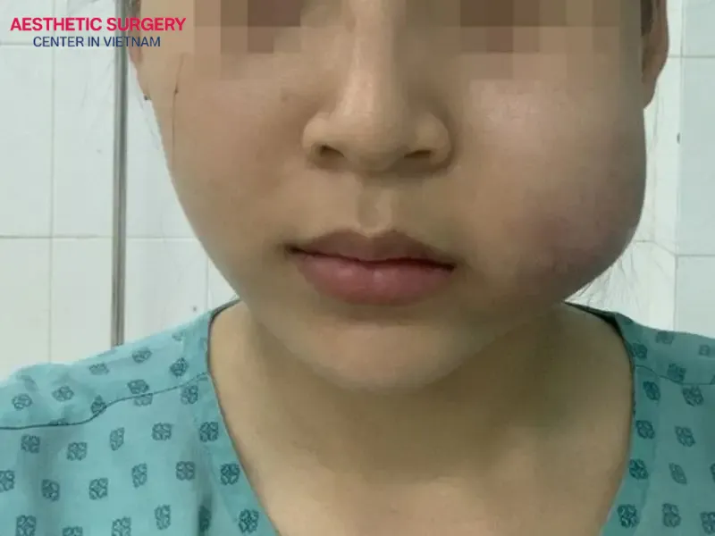 Avoid Low-cost facelift procedures as they can cause unpredictable complications after surgery