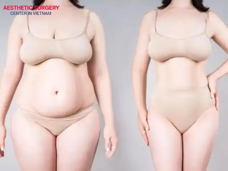 By week 6, the results of liposuction are clearly visible in small treated areas