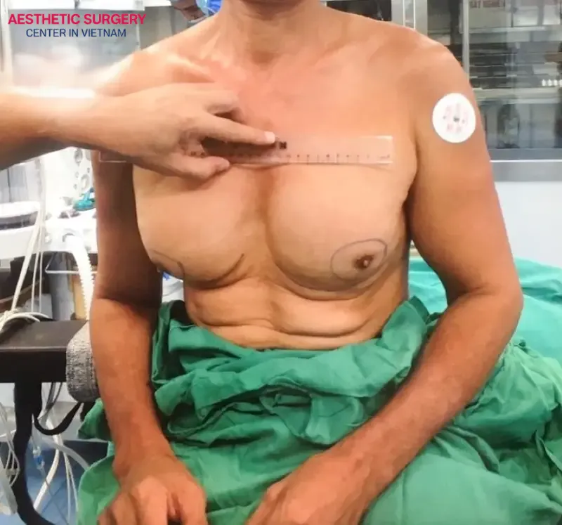 Aesthetic Surgery Center offers male breast reduction surgery