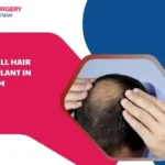Stem cell hair transplant