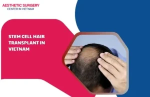 Stem cell hair transplant
