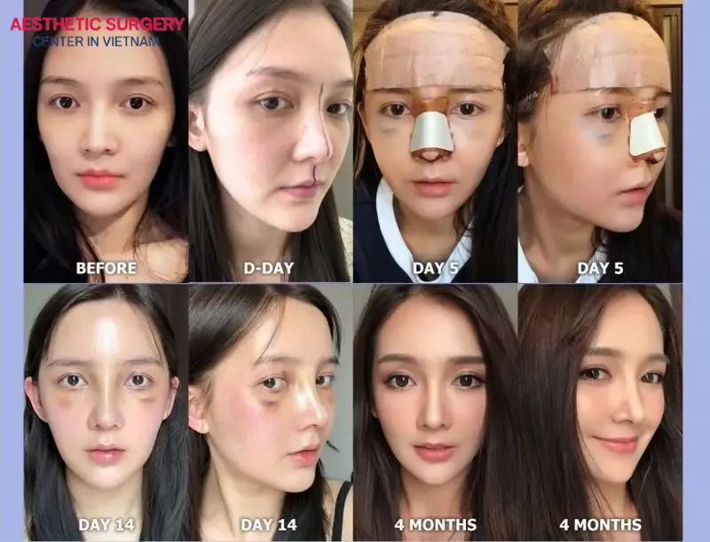 Recovery milestones after rhinoplasty within 4 months