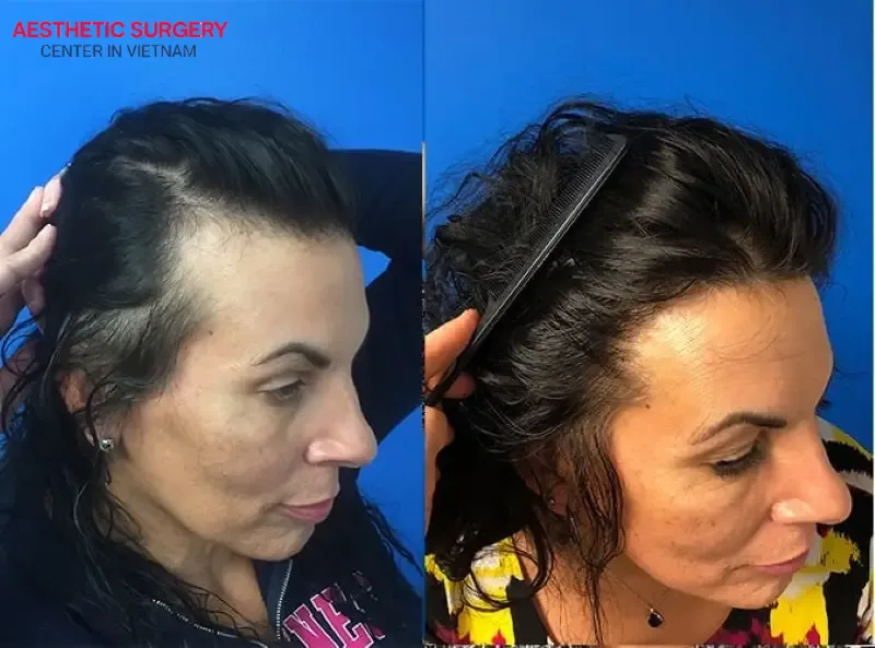 Sparse temple hair on both sides has been effectively restored after hair transplant
