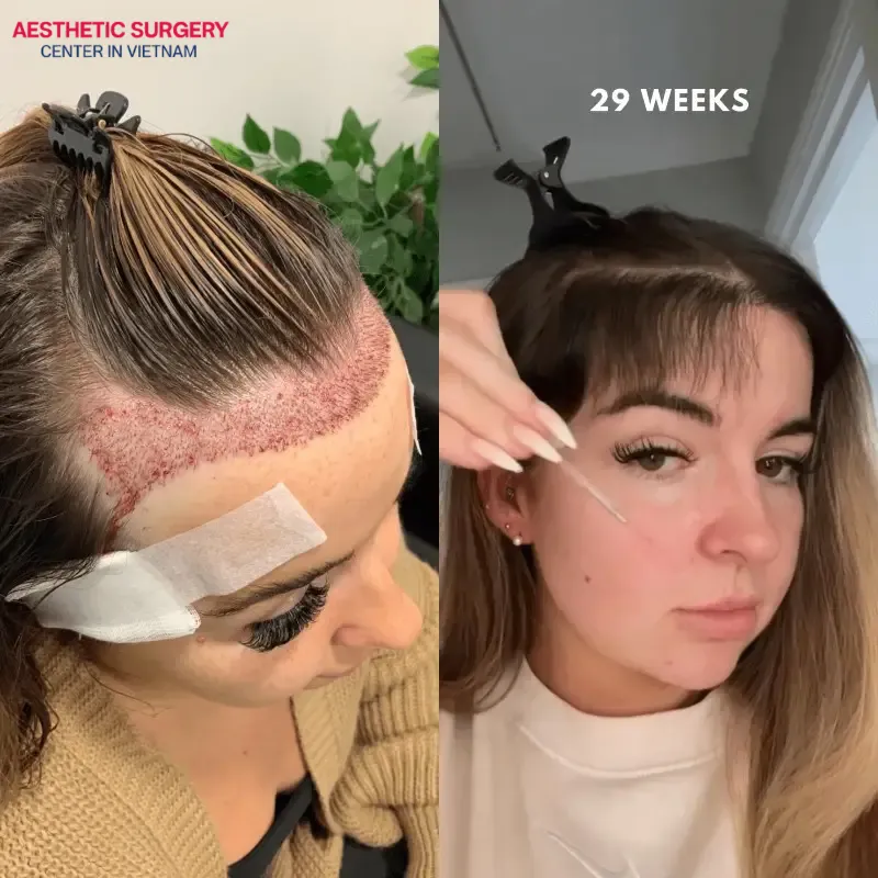 Images of a client before and after undergoing hairline and crown hair transplant to effectively cover bald areas and correct a high forehead