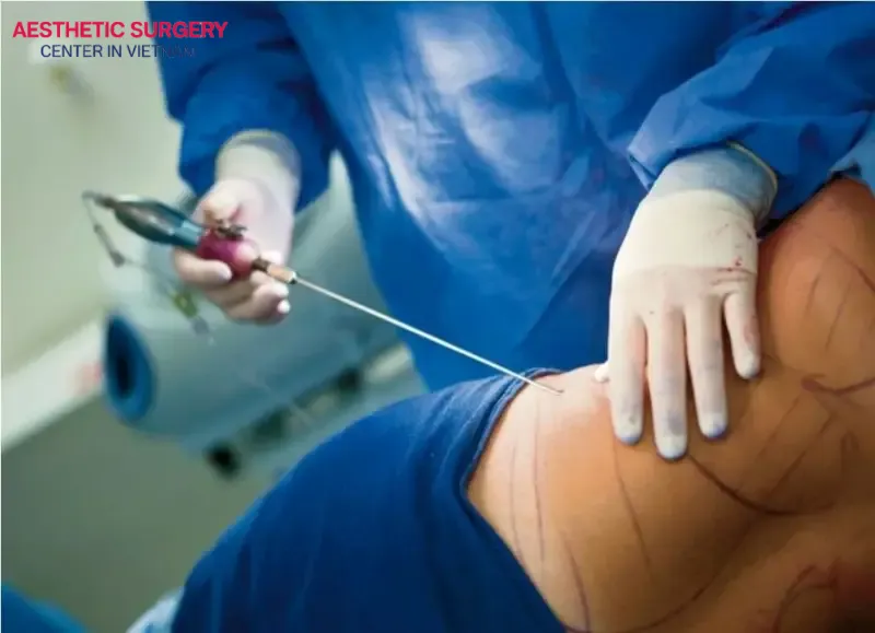 Does liposuction leave scars? Liposuction can leave scars, but they are small and tend to fade over time with proper care