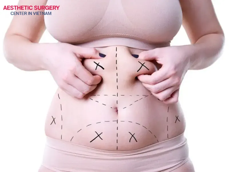 During weeks 1 to 2, the treated area may still experience swelling and mild discomfort, but bruising will have noticeably faded
