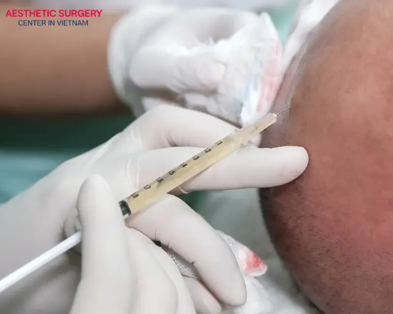 Stem cell hair transplant aims to stimulate hair growth in the most natural way