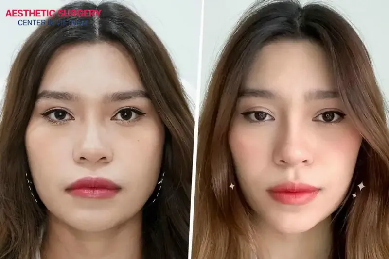 Botox prices are different in each major city in Vietnam.