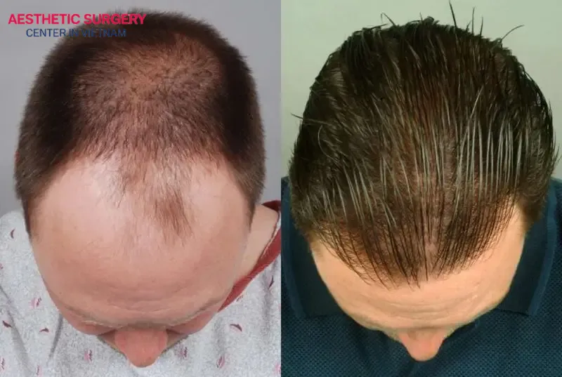 Hair transplant in Vietnam is not only effective but also provides long-lasting results
