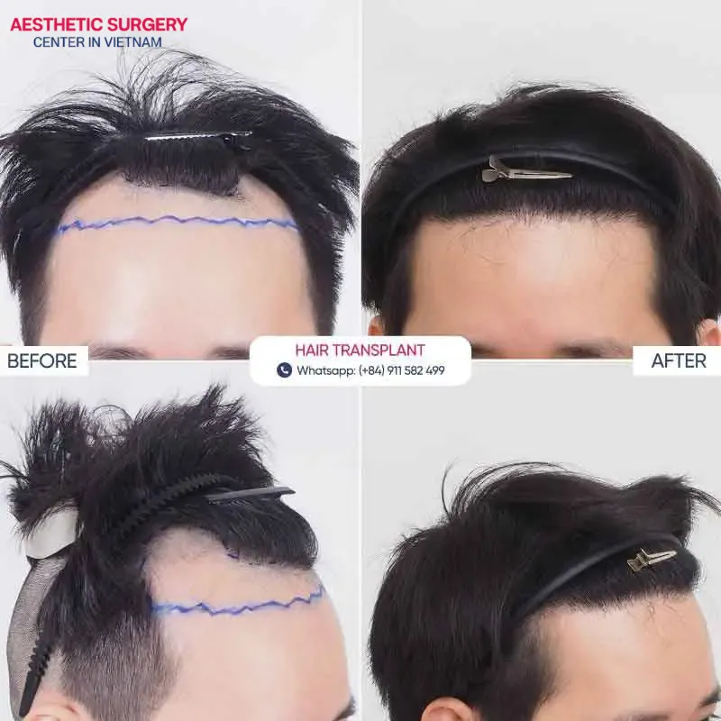 A client is highly satisfied with the hair transplant results at Aesthetic Surgery Center  