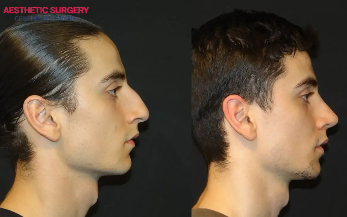 Male Rhinoplasty results: a high nasal bridge, sharp facial features, and a striking overall appearance