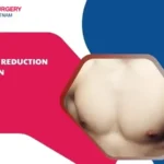Breast reduction for men