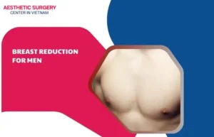 Breast reduction for men