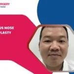 Bulbous nose rhinoplasty
