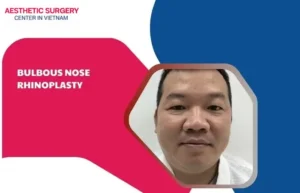 Bulbous nose rhinoplasty