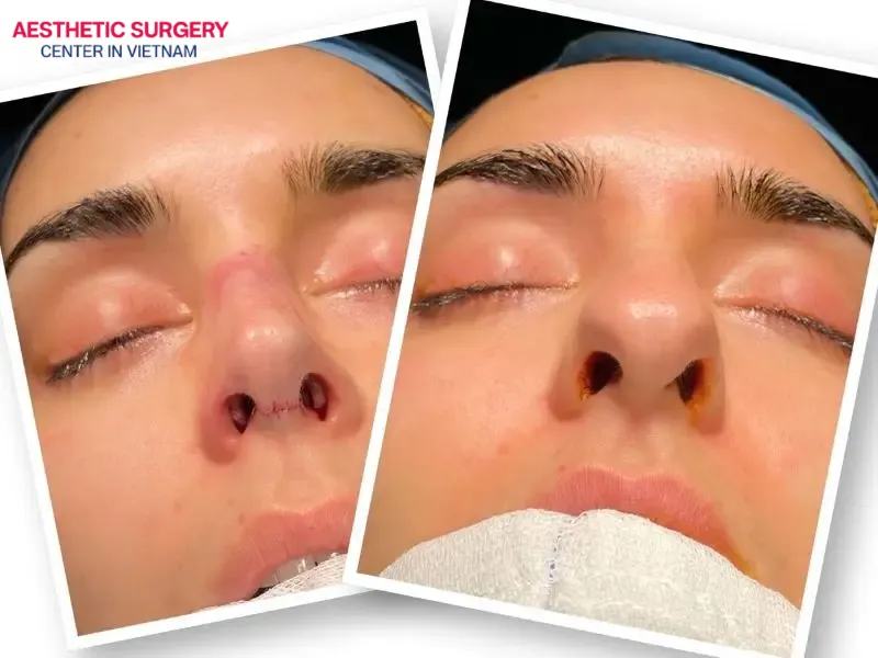 The open rhinoplasty technique includes a small incision between the nostrils