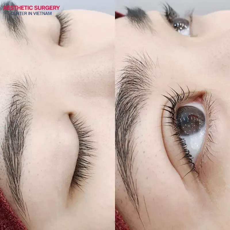 Eyelid surgery gives you well-defined, bigger, and more attractive double eyelids