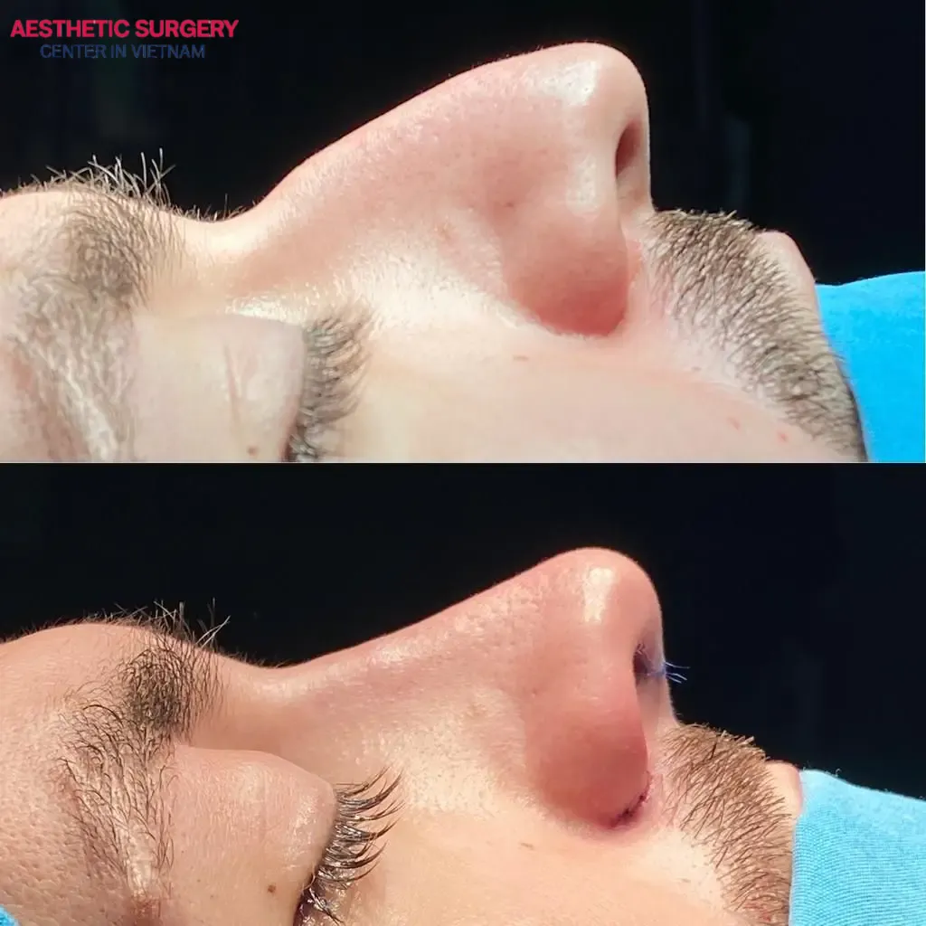 Male Rhinoplasty is performed following a standard medical procedure