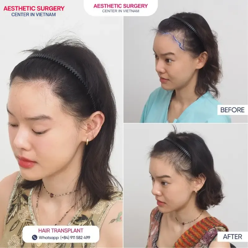 Images of a client before and after hair transplant at Aesthetic Surgery Center