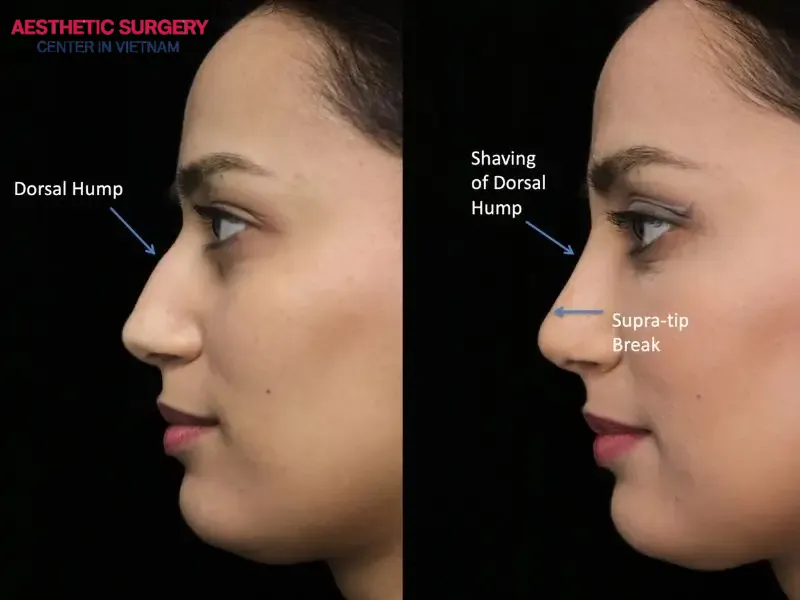 Closed rhinoplasty is a suitable bulbous nose surgery technique for mild to moderate cases