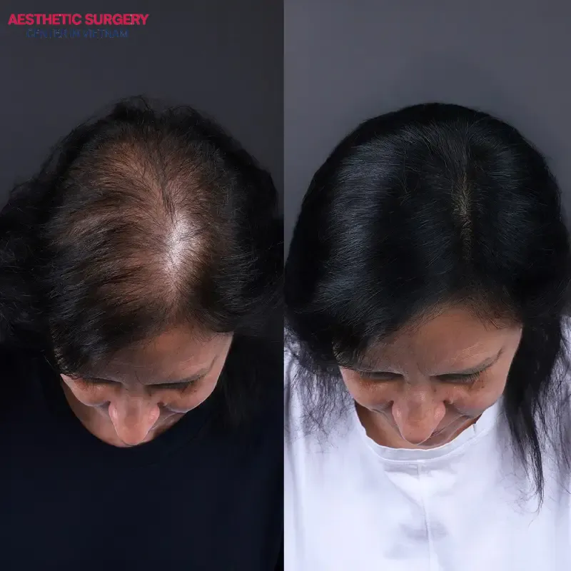 The condition of severe hair loss at the crown has been significantly improved after a female hair transplant