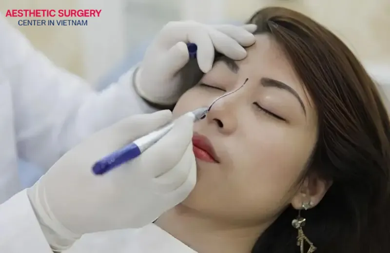 Frequently asked questions about rhinoplasty