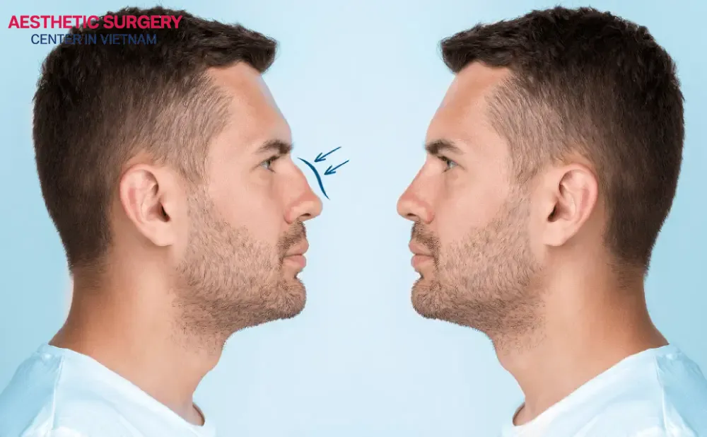 Male Rhinoplasty brings many excellent benefits