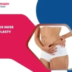 Liposuction recovery time
