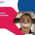 Rhinoplasty swelling stages
