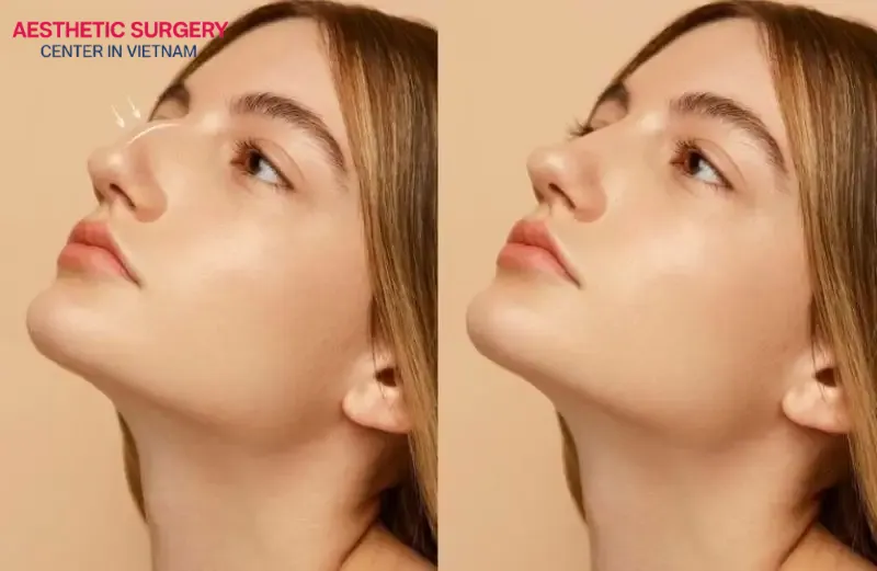 Rhinoplasty helps reshape the nose into a straighter, more refined form, enhancing the overall elegance of the face