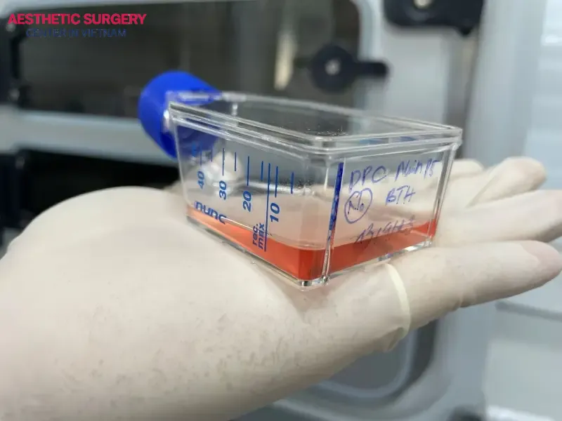 Stem cells will be extracted and directly transplanted into the scalp area requiring treatment