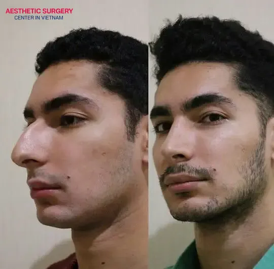 Results of structural Rhinoplasty for men: a straight, harmonious nasal bridge, creating a stronger and more confident facial appearance