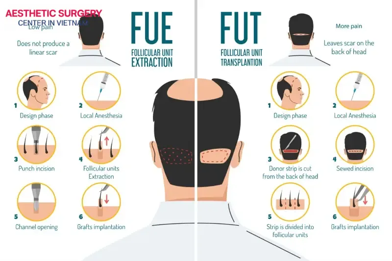 FUT strip harvesting and FUE individual follicle extraction have some notable differences in their procedure