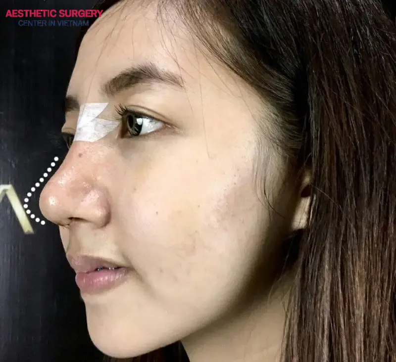 The swelling and recovery time of the nose varies for each person, as it depends on many factors