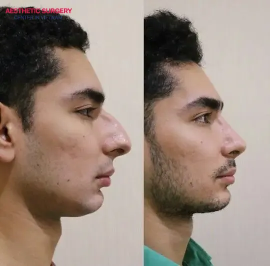 Before and after Male Rhinoplasty: the original low nose is reshaped into a naturally high and masculine profile