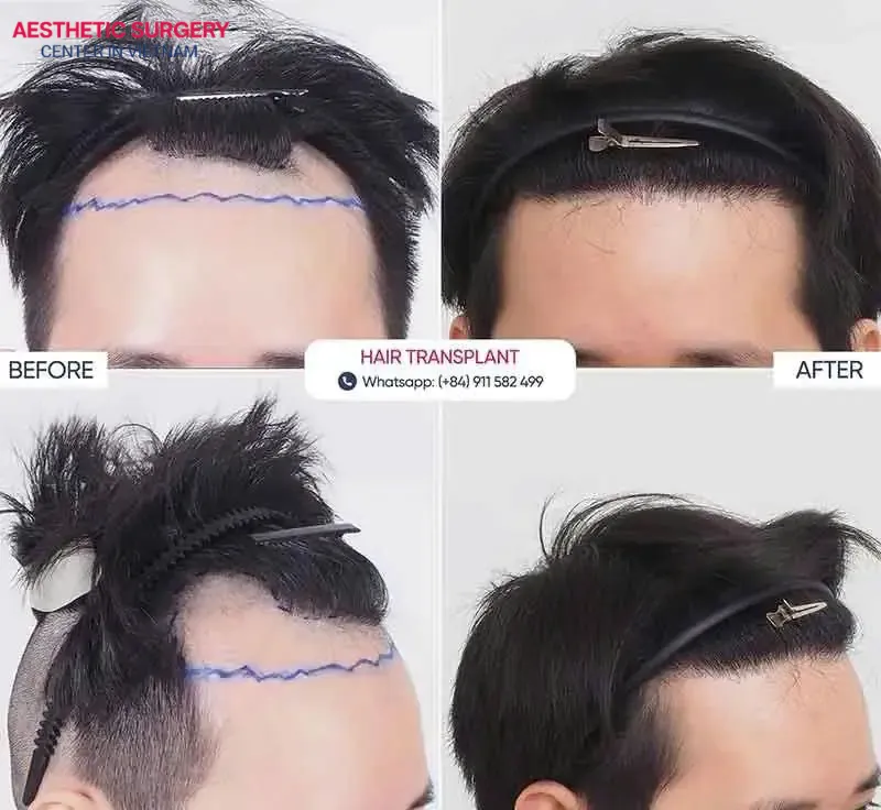 Before-and-after images of clients undergoing hair transplantation at Aesthetics Surgery Center