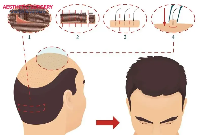 This method involves dividing a strip of scalp into smaller sections using a scalpel