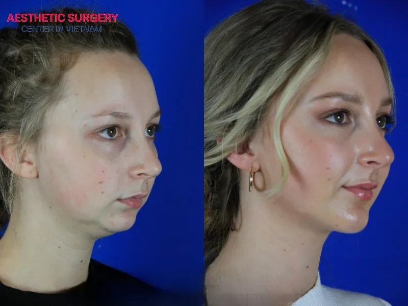 Chin augmentation surgery uses either artificial or autologous materials to enhance the shape and proportion of the face.