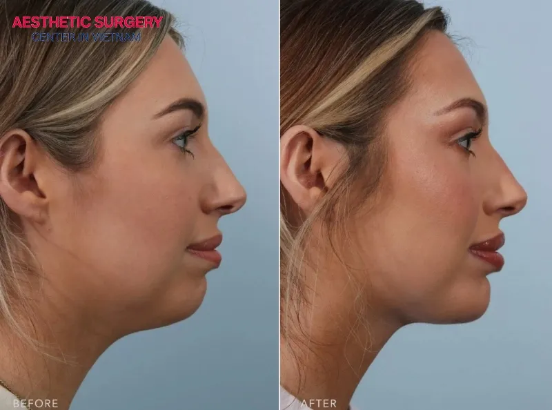 High-quality, biocompatible chin implants help ensure safety and minimize the risk of rejection, providing long-lasting and natural-looking results.