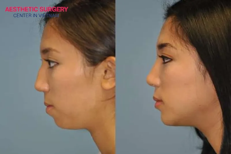 The cost of chin augmentation ranges from 700 to 1,800 USD.