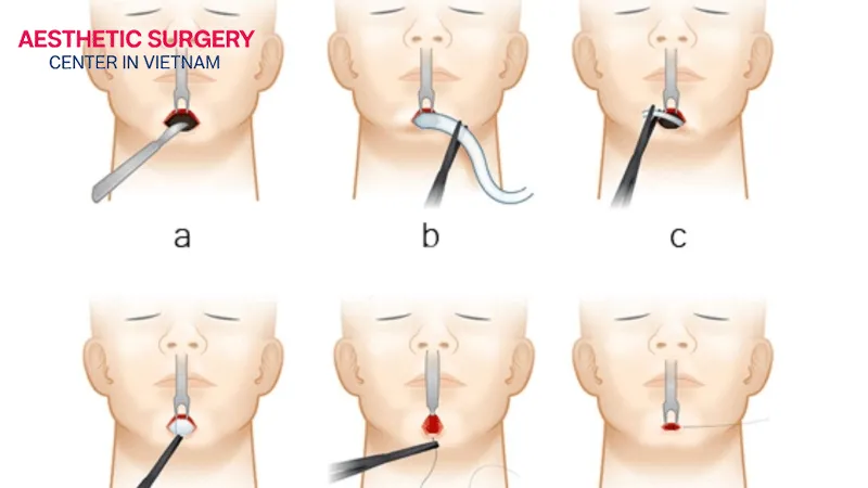 Medical-Standard Chin Augmentation Procedure
