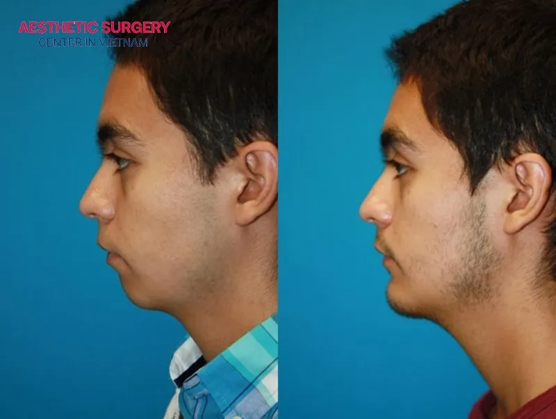 The face looks more youthful and harmonious after chin augmentation.